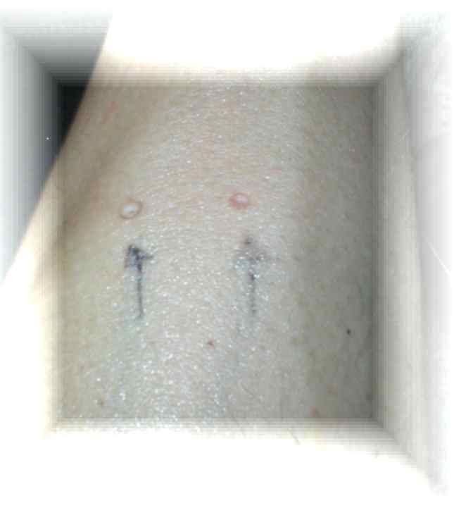 after treatment